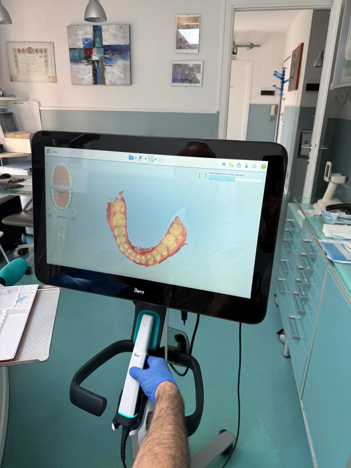 Scansione intraorale iTero — arcata inferiore
