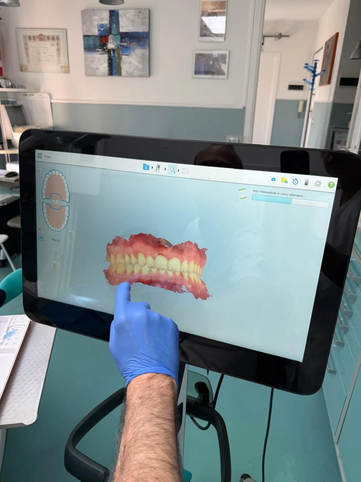 Scansione intraorale iTero — occlusione